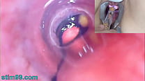 Cámara de endoscopio de mirilla de mujer madura en la vejiga con bolas