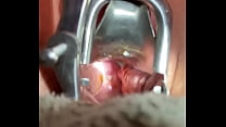 Inserting Foley into cervix